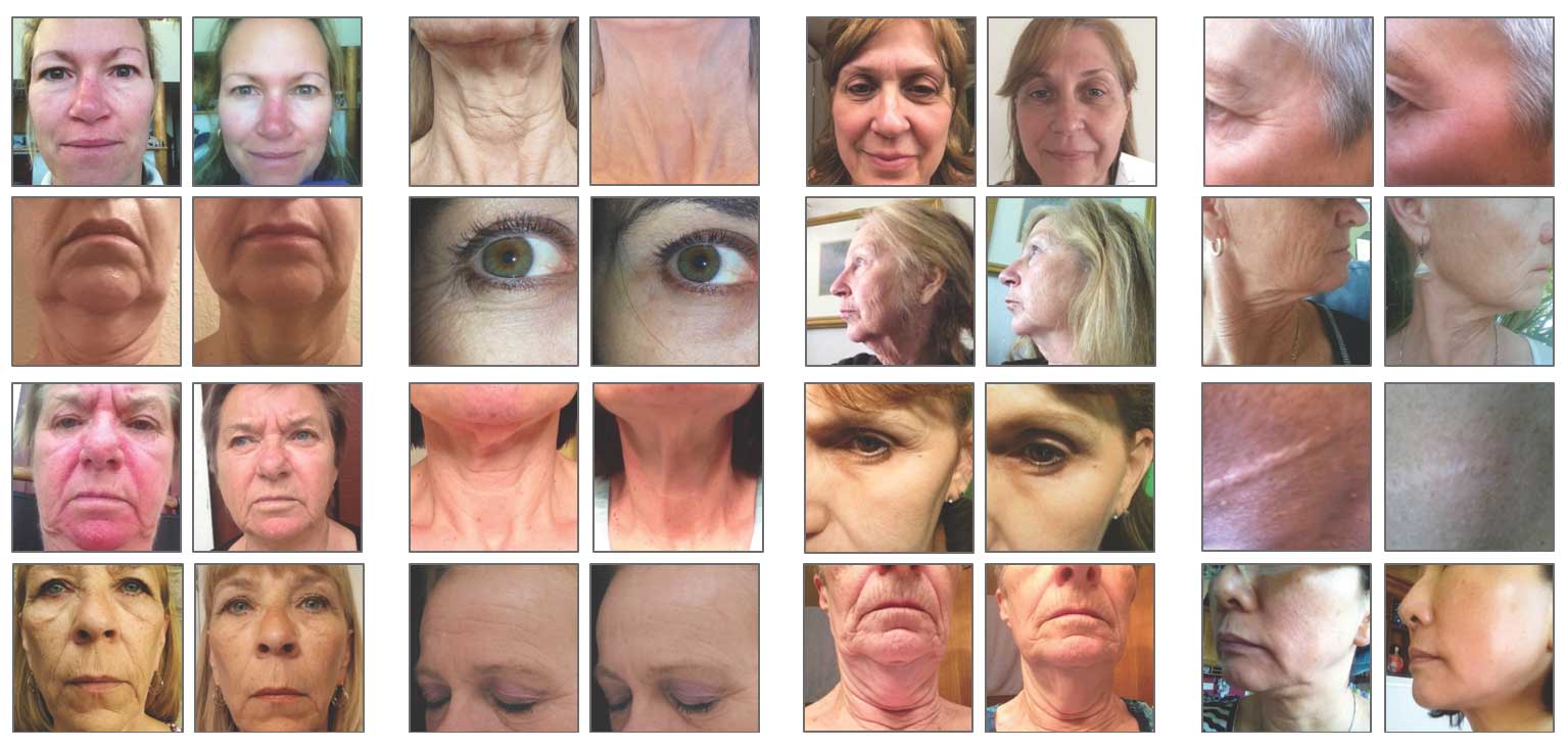 Before-After-Skin-care-pictures